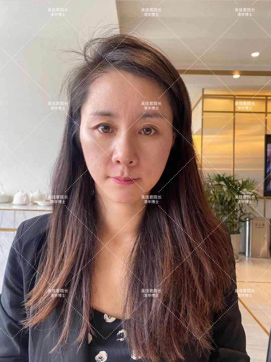 拉皮手术后三个月的恢复过程,拉皮术后10天白天可以不戴头套吗