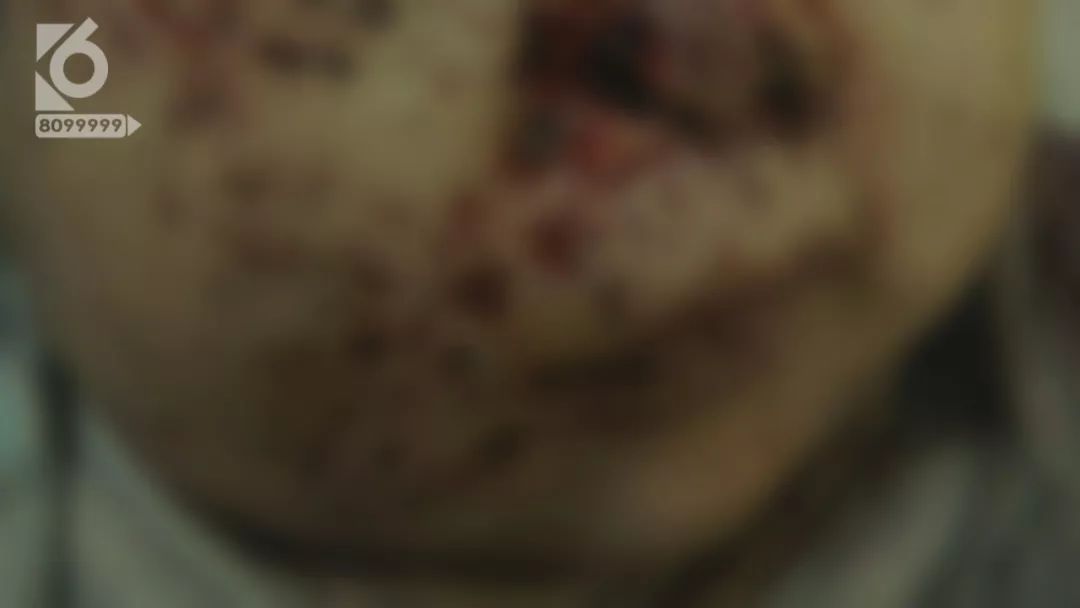 老鼠啃三个月婴儿事件,婴儿熟睡时被老鼠啃食新闻