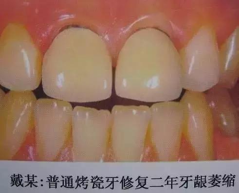 换一副烤瓷牙什么材料比较好,各类烤瓷牙材料的优缺点对比