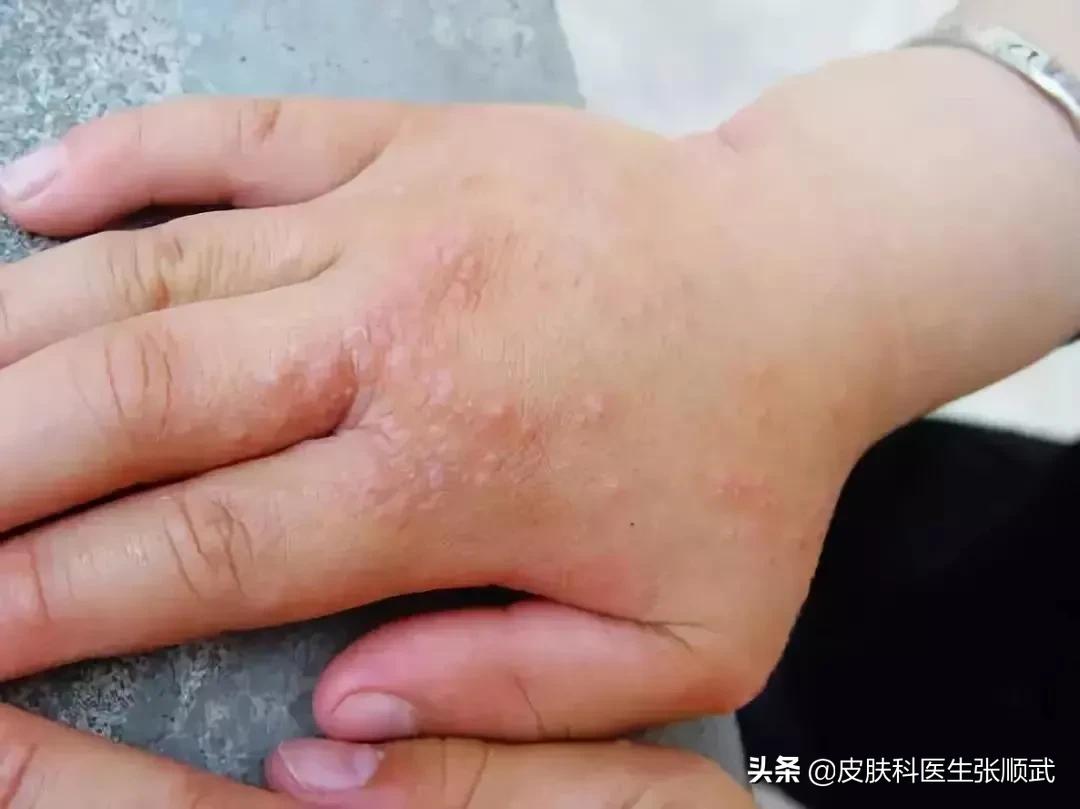 手上小水泡汗疱疹,脚上手上起小水泡很痒可以根治吗