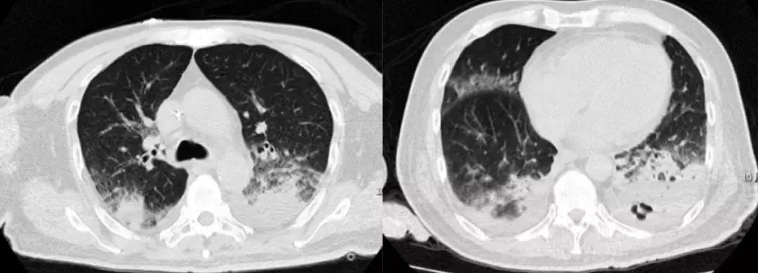 抗菌药物不合理处方分析,抗菌药物用药不合理的表现