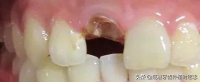 只剩残根的牙真的能补救吗,烂的只剩下黑色残根的牙怎么处理