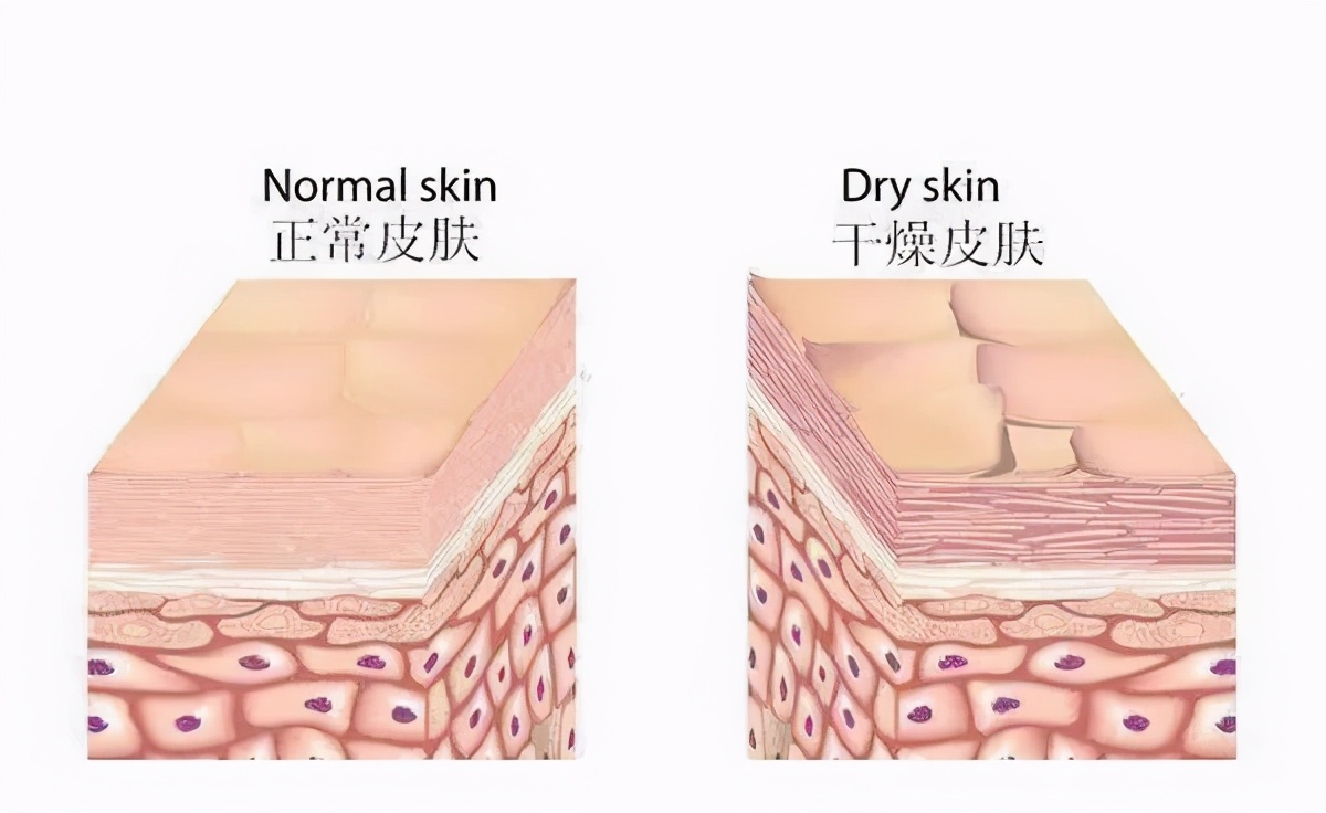 脸干爆皮还长痘怎么补救最快,干皮修护皮肤屏障长痘