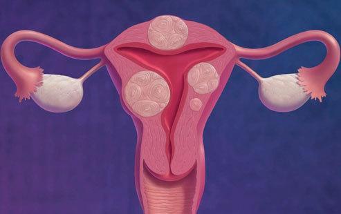 同仁堂子宫肌瘤中成药,子宫肌瘤最好中成药