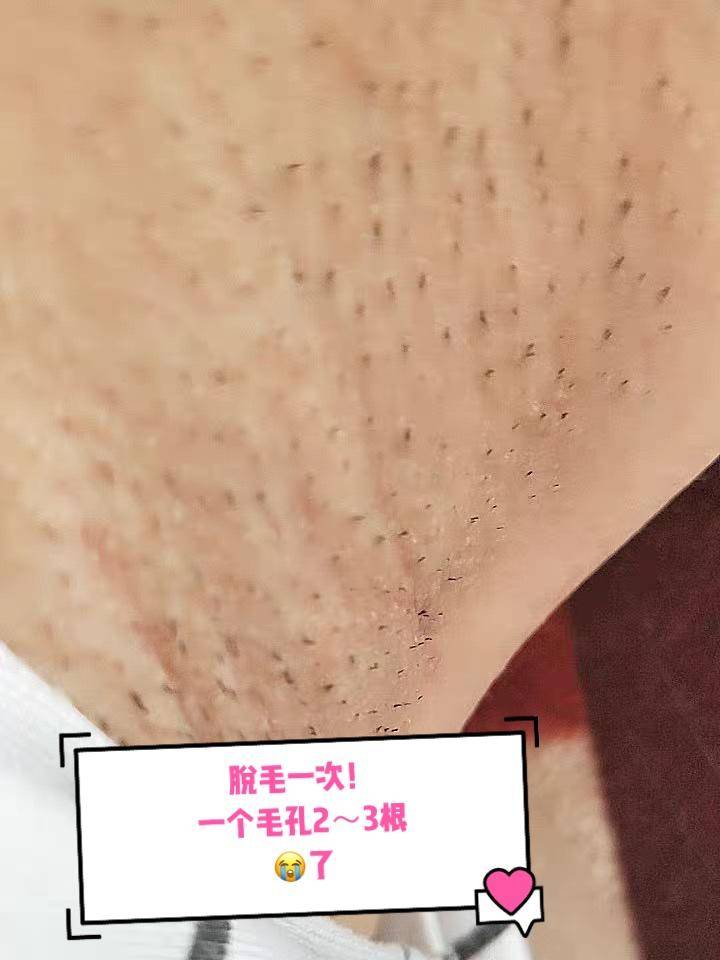 ulike蓝宝石脱毛仪真的好用吗,partyplus脱毛仪好用吗