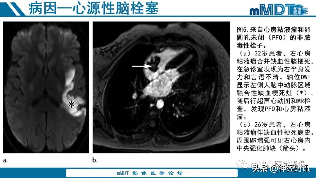 急性缺血性脑卒中ppt素材图片,青年缺血性脑卒中ppt