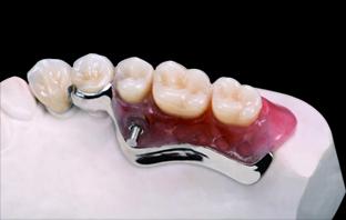 有舒服的活动义齿吗,装一颗活动义齿最舒服的是哪一种