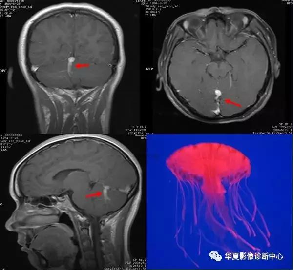 颅脑核磁影像解剖图谱,颅脑mr增强影像图片
