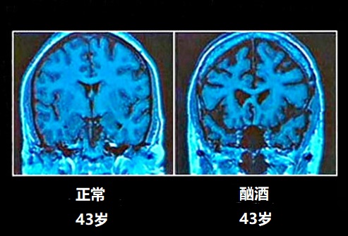 常年喝酒的人身体怎么样了,喝酒注意事项和饮酒量