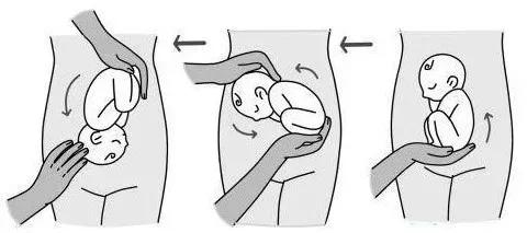 孕妇生产胎位不正准妈妈想放弃,宝宝胎位不正会影响智力发育么