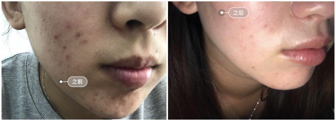 超好用的祛痘膏便宜,有没有好用的祛痘膏推荐女孩子