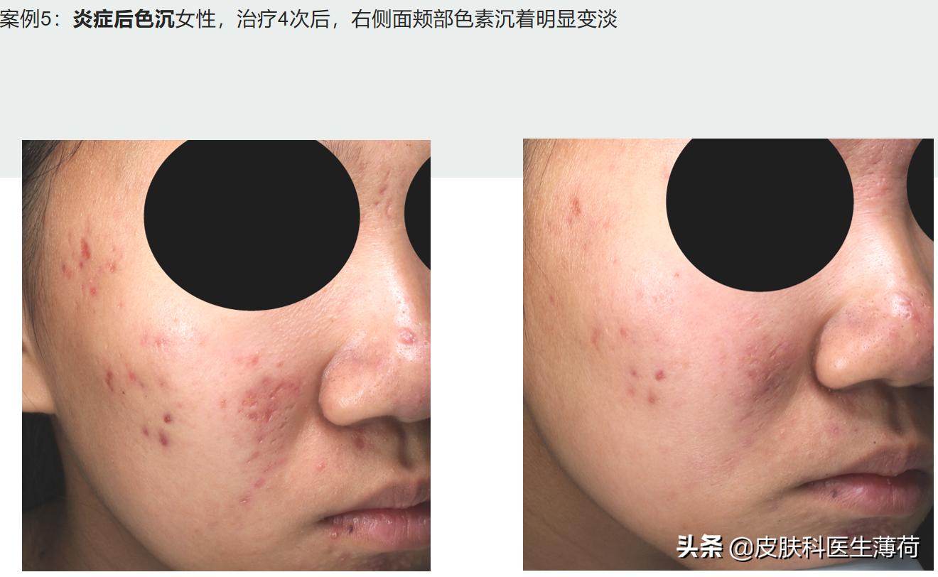 水杨酸果酸毛孔收缩精华测评,水杨酸精华适合所有痘肌