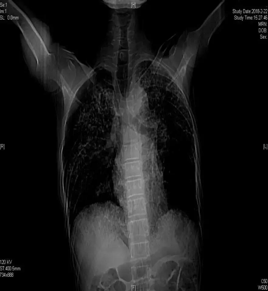 肺纤维化病例,肺纤维化手指甲发紫还能活多久