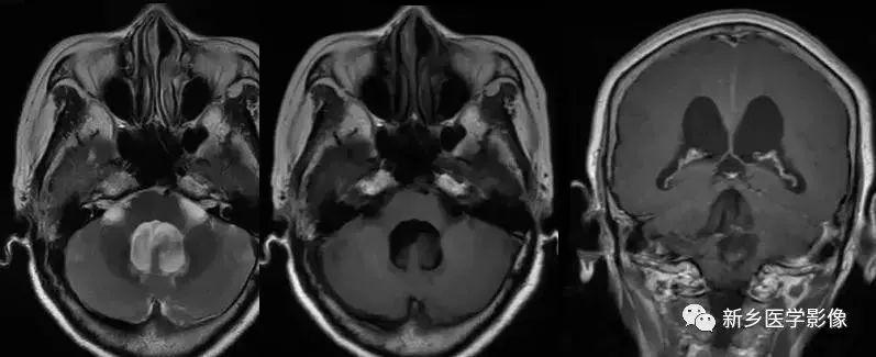 什么引起成人脑室扩大,哪些病可以导致左侧脑室增宽