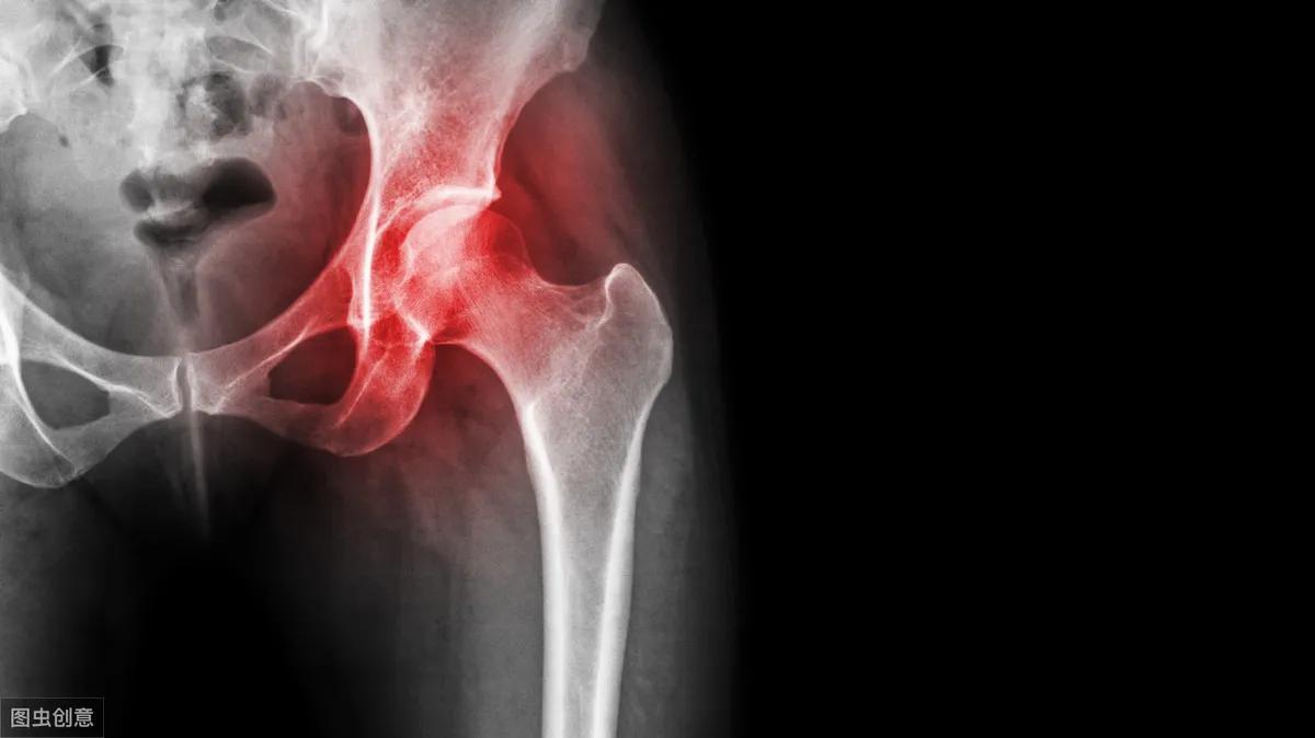 老人髋部骨折怎样保守治疗,83岁老人摔倒致髋部骨折