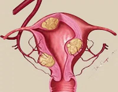子宫肌瘤的10个前兆,子宫肌瘤有八个注意事项