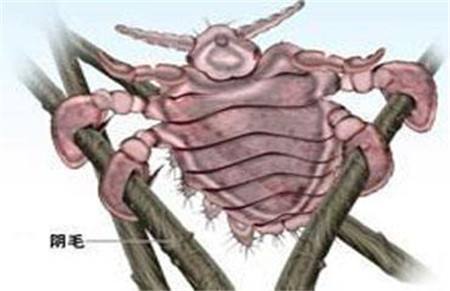 张医生讲传染疾病（一）：藏在男女私密部位的阴虱，最爱感染女性