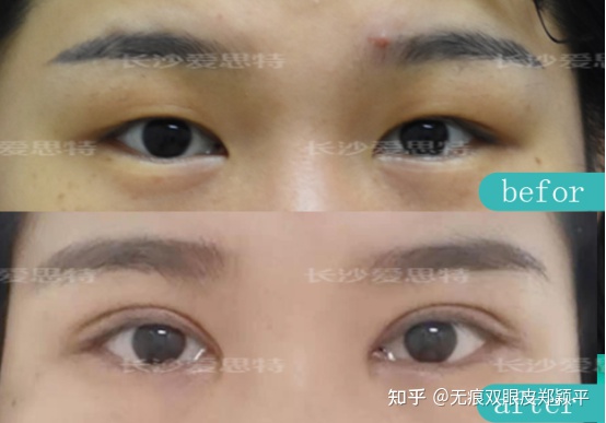 刚割双眼皮的样子,割双眼皮增生是什么样子