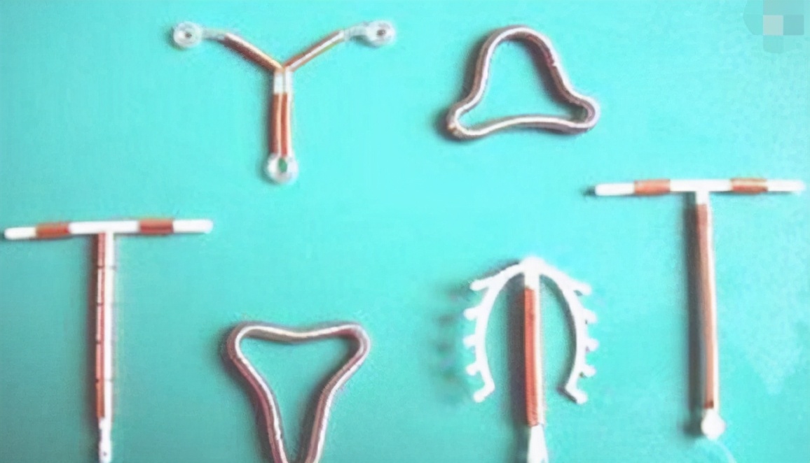 子宫里放节育环,钉在子宫上的节育环会不会掉