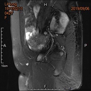宫外孕保守治疗显示子宫腺肌症,子宫腺肌病保守治疗无效怎么办