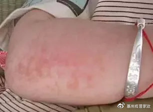 婴儿尿布湿疹的最快自愈方法,婴儿湿疹痤疮尿布疹