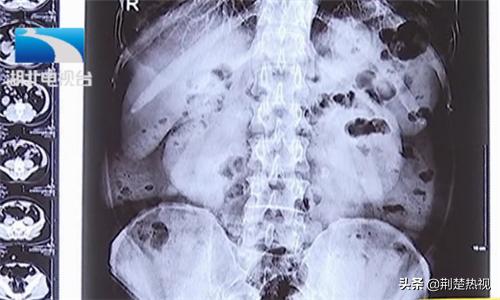 男27岁肾结石并积水经常腰疼背疼,男性轻度肾积水尿频尿急尿不尽