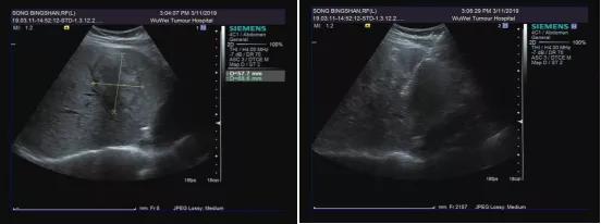 针尖上的艺术超声介入消融术,超声下穿刺针尖显影技巧