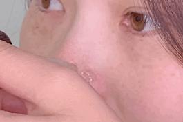 长黑头VS不长黑头差距这么大?精致女孩如何绕过黑头这道坎?