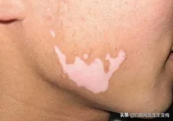 白癜风真的一旦得了就治不好吗,白癜风真的治不好了吗