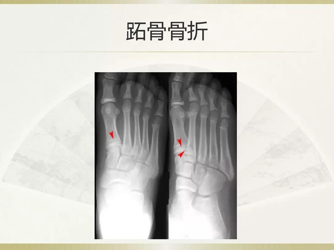 骨科x光片读片技巧,放射科骨科读片教程