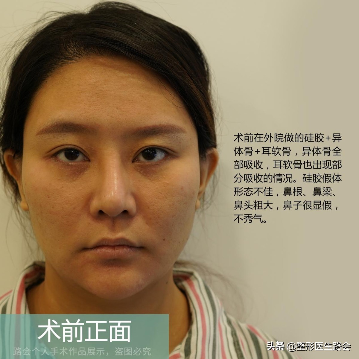 一定得惊艳才好看吗,膨体鼻整形全过程