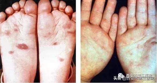 宝宝手足口病腿上都是红点点,宝爸宝妈刚看小孩子的表现