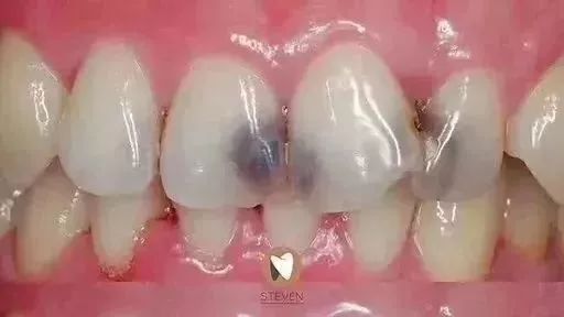 全瓷牙冠在保质期可以免费重做吗,全瓷牙冠价格表2021款报价