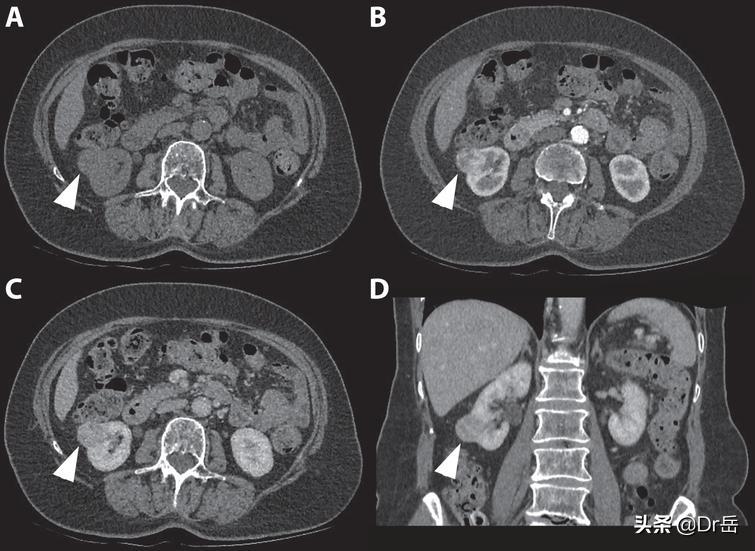 肾癌晚期肺转移痔疮敢动手术吗,肾癌做保肾手术好还是切除手术好
