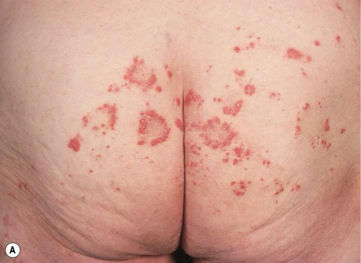 过敏性紫癜算是风湿病的一种吗,风湿性关节炎与过敏性紫癜区别