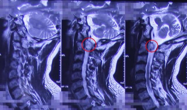椎管内肿瘤跟椎管肿瘤一样吗,椎管内肿瘤是癌吗