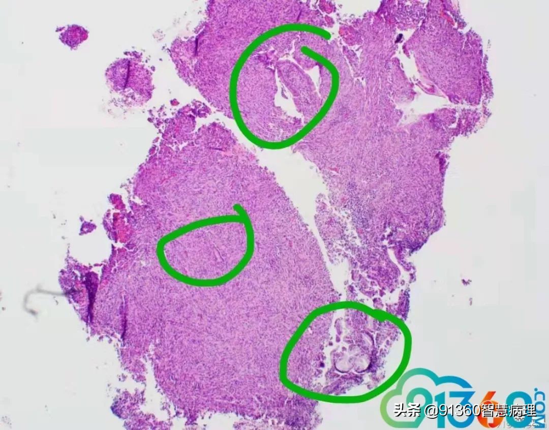 宫颈腺癌silvaa型用化疗吗,宫颈腺癌silvab型需要放疗几次