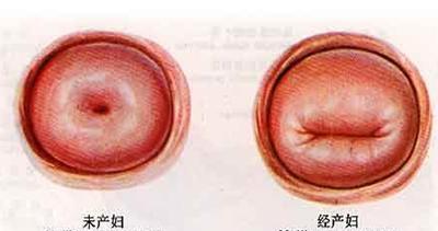 绝经5年又出血,妇科医生:取环要趁早,长到肉里太受罪