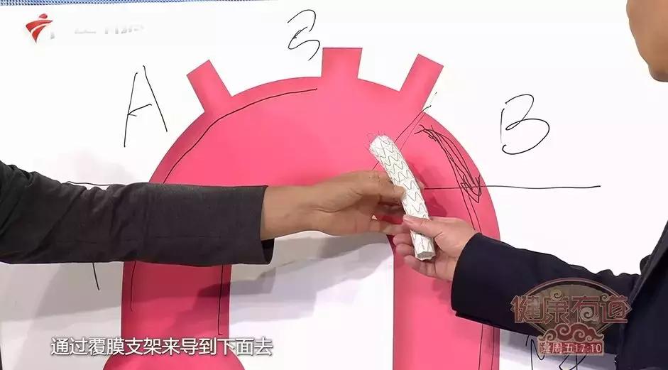 主动脉夹层手术后会猝死吗,主动脉夹层破裂猝死有救吗