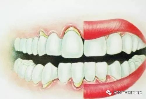 牙齿一咬硬东西就疼怎么回事,补过的牙齿咬了硬物痛起来怎么办