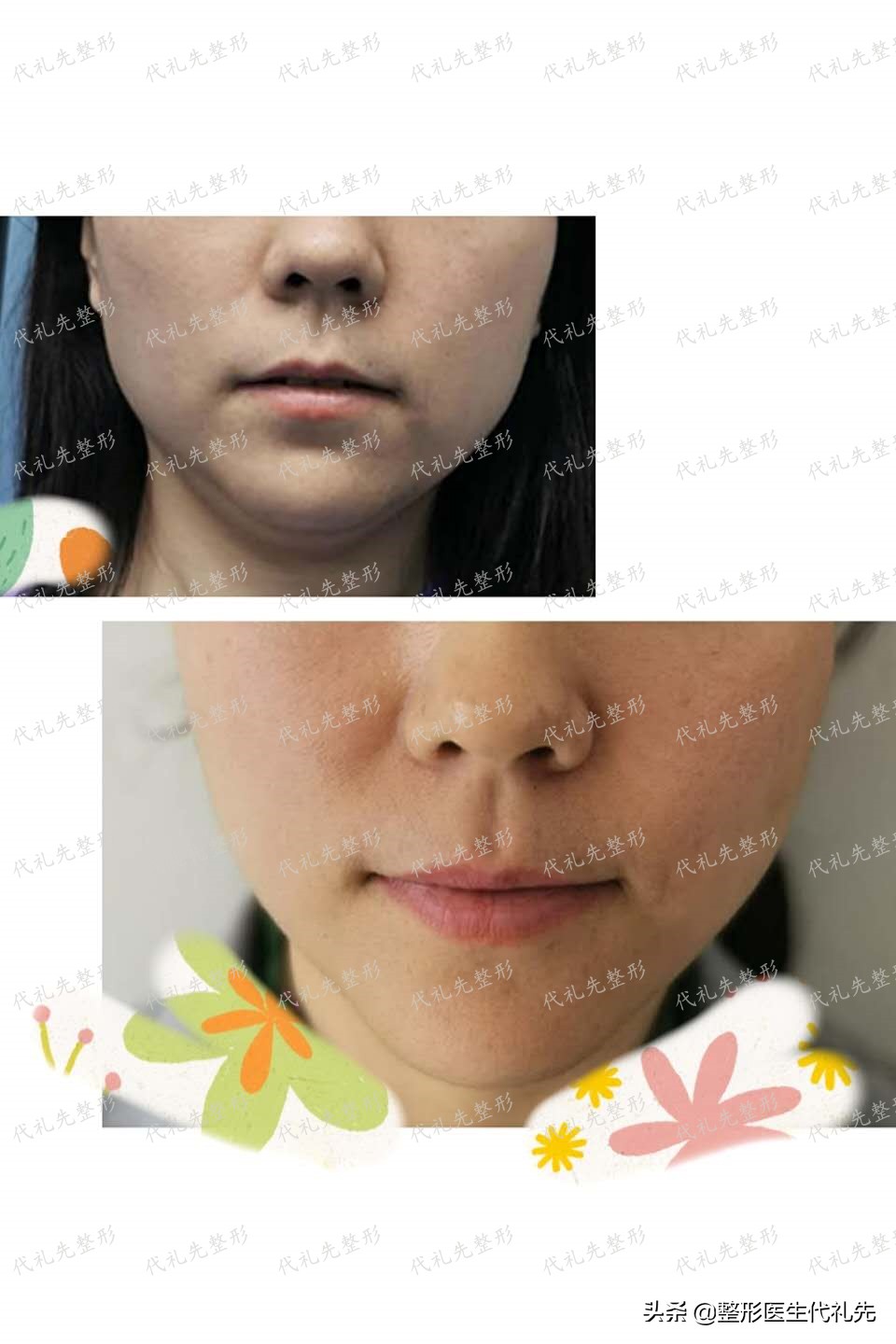 做脸部线雕埋线注意什么,面部线雕消肿的最佳方法