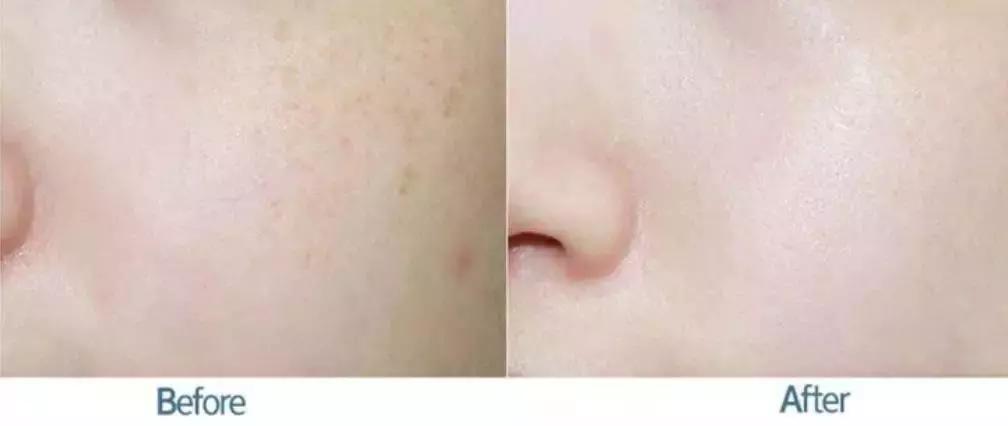 祛脸上斑点色斑的小妙招,一个动作教你如何淡化色斑