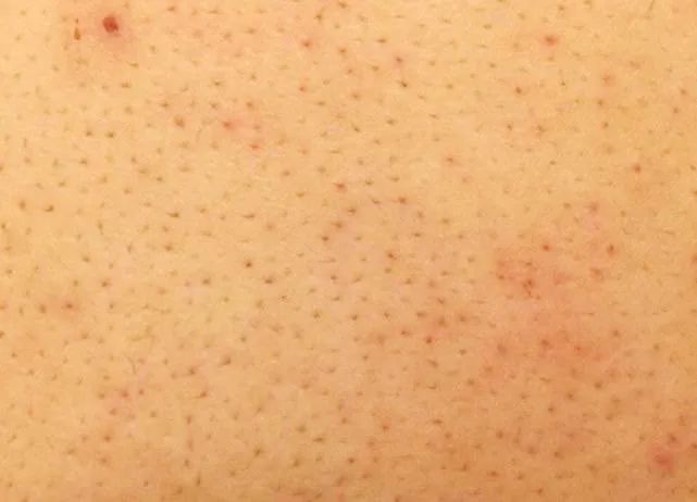 美背长痘,后背长痘的美背方法