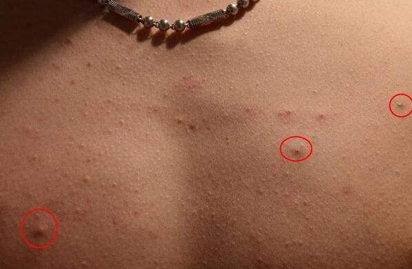 后背小痘痘一挤就出来了怎么治疗,后背长的疙瘩一抠就出血