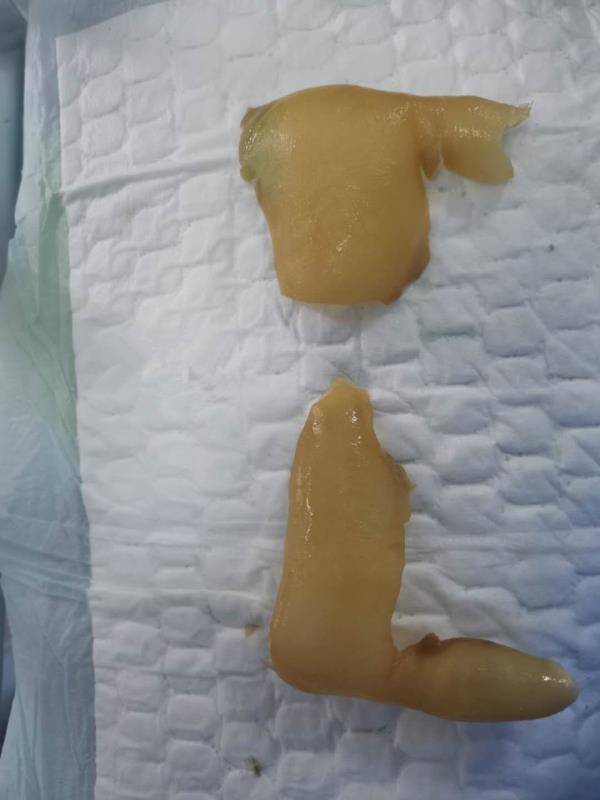 13岁男孩患罕见病后来怎么样了,湖南罕见病儿童