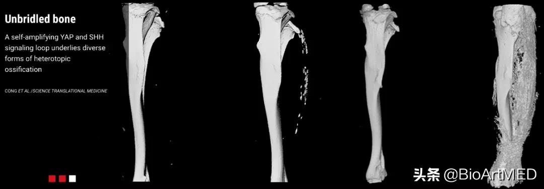 进展|哈佛华人教授团队揭示异位骨化形成及扩展的新机制​