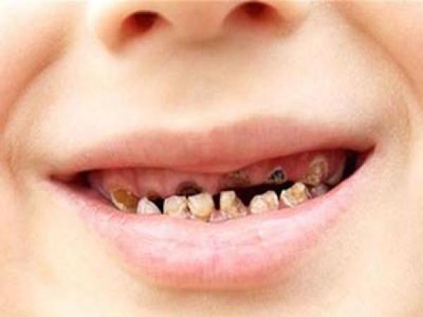 宝宝牙齿黑垢越来越黑怎么办,小孩牙齿有黑渍怎么补救