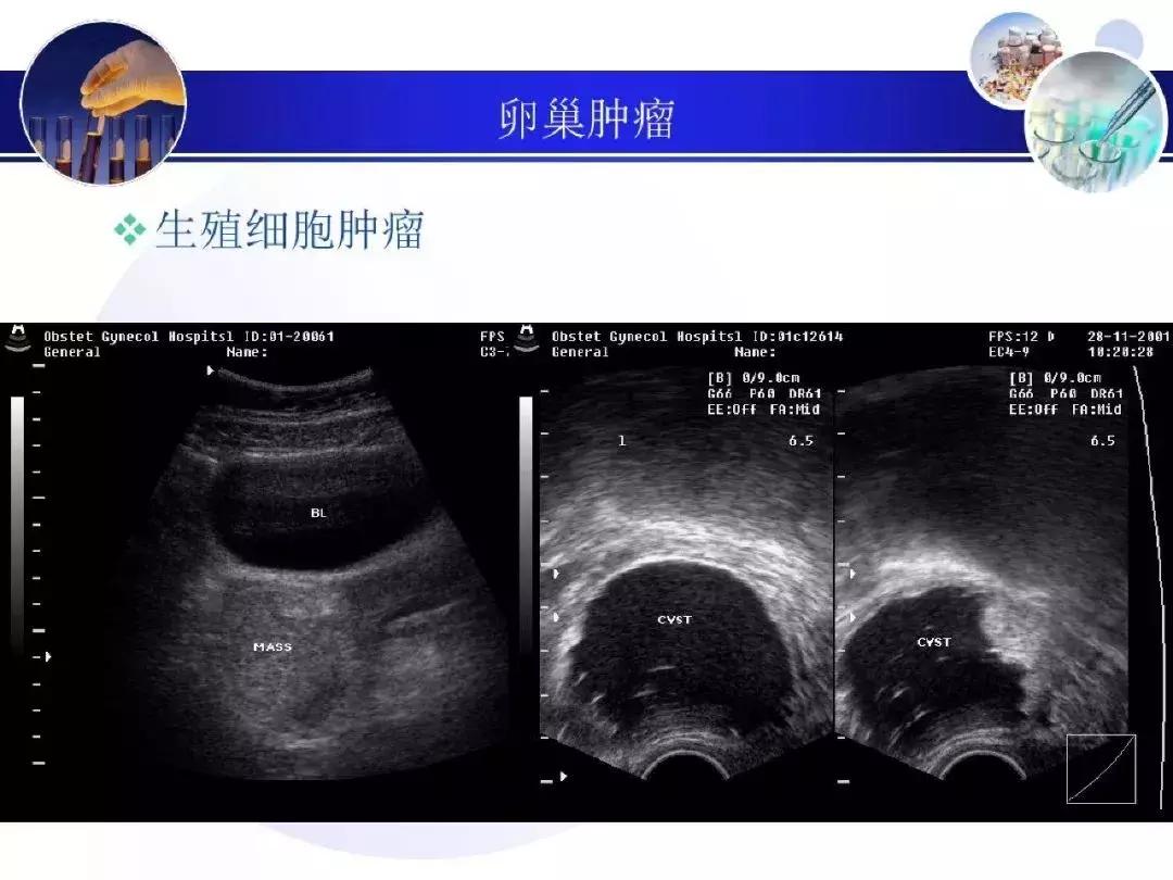 纯干货！子宫及附件解剖和超声诊断