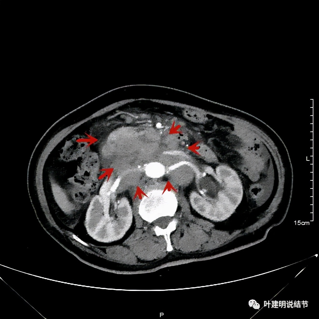 特瑞普利单抗食管癌成功案例,特瑞普利单抗治疗食管癌效果好吗
