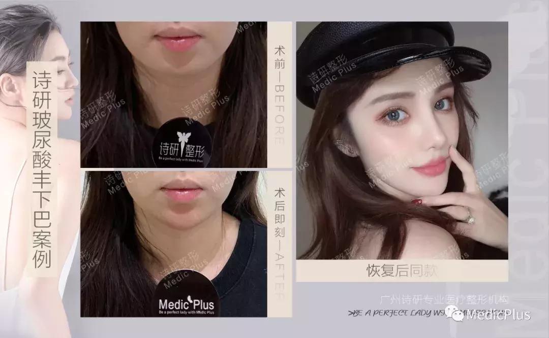 丰下巴可以改善下巴后缩么,丰下巴手术前后对比照片